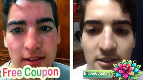 Acne: Effective Solution from the Root